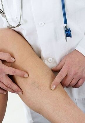 Żylaki kończyn dolnych