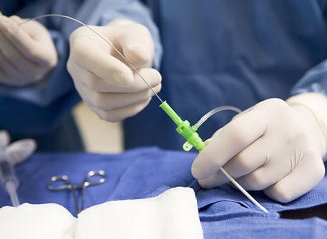 Ablacja częstotliwością radiową